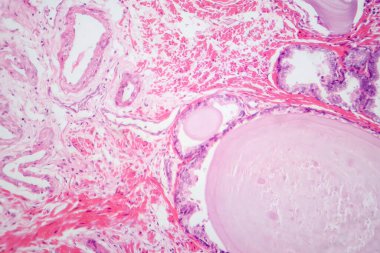 İyi huylu protez hiperplazisinin histolojik özelliklerini gösteren bir fotoğraf. Glandüler ve stromal bileşenlerin çoğalması ile birlikte büyümüş prostat bezi..