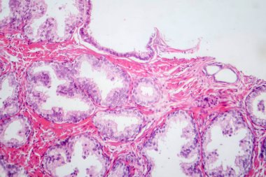 İyi huylu protez hiperplazisinin histolojik özelliklerini gösteren bir fotoğraf. Glandüler ve stromal bileşenlerin çoğalması ile birlikte büyümüş prostat bezi..