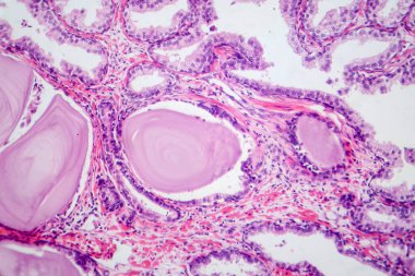 İyi huylu protez hiperplazisinin histolojik özelliklerini gösteren bir fotoğraf. Glandüler ve stromal bileşenlerin çoğalması ile birlikte büyümüş prostat bezi..