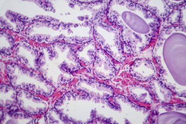İyi huylu protez hiperplazisinin histolojik özelliklerini gösteren bir fotoğraf. Glandüler ve stromal bileşenlerin çoğalması ile birlikte büyümüş prostat bezi..