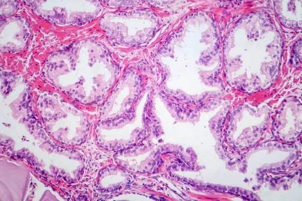 Photomicrograph Showing Histological Features Benign Prostatic Hyperplasia Enlarged Prostate Gland — Stock Photo, Image