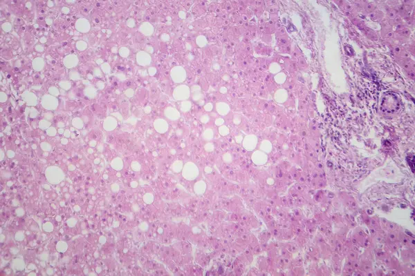 stock image Light micrograph revealing liver tissue with fatty infiltration, indicative of hepatic steatosis or fatty liver disease.