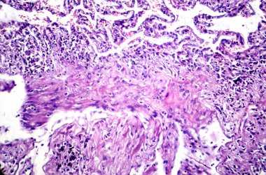 Sigara içen kişinin akciğerinin fotomikroskobu, uzun süreli sigara içme alışkanlıkları ile ilişkili karakteristik değişiklikleri ve hasarları ortaya koymaktadır..