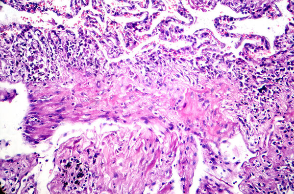 Фотомикрограф легких курильщика, выявление характерных изменений и повреждений, связанных с длительными привычками курения.