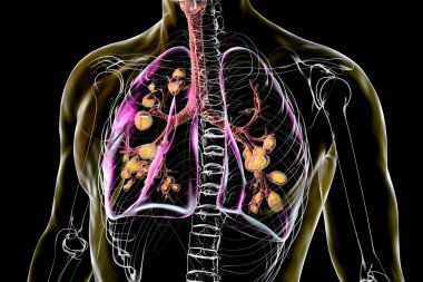 Kistik fibrozisten etkilenen akciğerler, yoğun mukus üretimine neden olan genetik bir bozukluk. 3 boyutlu illüstrasyon, mukus birikimi ve iltihaplanmasına bağlı bronşların genişlediğini gösteriyor..