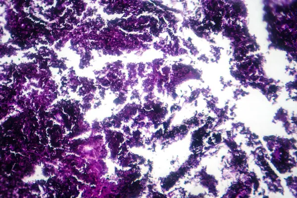 肺组织的显微照片 在显微镜下描绘矽肺病理学 揭示肺泡和纤维化中二氧化硅颗粒的堆积 — 图库照片