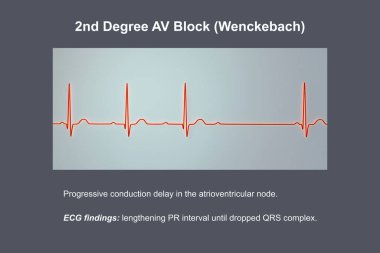 3D illustration visualizing an ECG of 2nd degree AV block (Wenckebach), highlighting abnormal electrical conduction in the heart rhythm. clipart