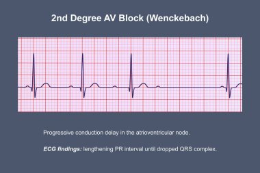 AV bloğunun (Wenckebach) ECG görüntülemesi, kalp ritmindeki anormal elektriksel iletimi vurguluyor.