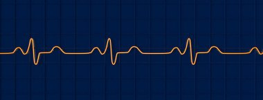 3 boyutlu bir ECG 'yi Bundle şubesi bloğu ile görselleştirme, genişletilmiş QRS kompleksleri, değiştirilmiş ventriküler depolarizasyon.