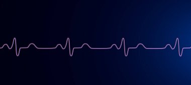 3 boyutlu bir ECG 'yi Bundle şubesi bloğu ile görselleştirme, genişletilmiş QRS kompleksleri, değiştirilmiş ventriküler depolarizasyon.
