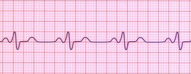 3 boyutlu bir ECG 'yi Bundle şubesi bloğu ile görselleştirme, genişletilmiş QRS kompleksleri, değiştirilmiş ventriküler depolarizasyon.