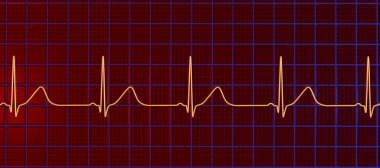 3D illustration of an electrocardiogram (ECG) showing prolonged QT interval with broad-based T-waves, characteristic of type 1 long QT syndrome. clipart
