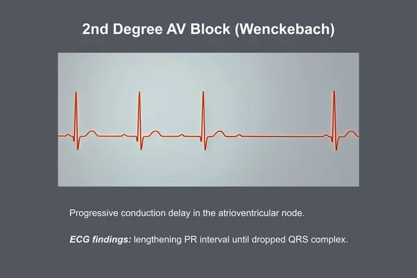 Ilustração Visualizando Ecg Graus Bloqueio Wenckebach Destacando Condução Elétrica Anormal — Fotografia de Stock
