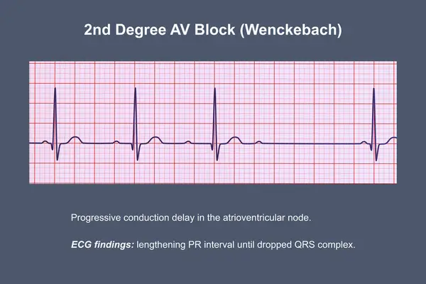 Illustration Visualizing Ecg 2Nd Degree Block Wenckebach Highlighting Abnormal Electrical — Stock Photo, Image
