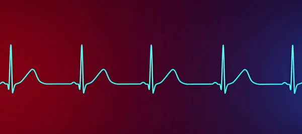 Illustration Electrocardiogram Ecg Showing Prolonged Interval Broad Based Waves Characteristic — Stock Photo, Image