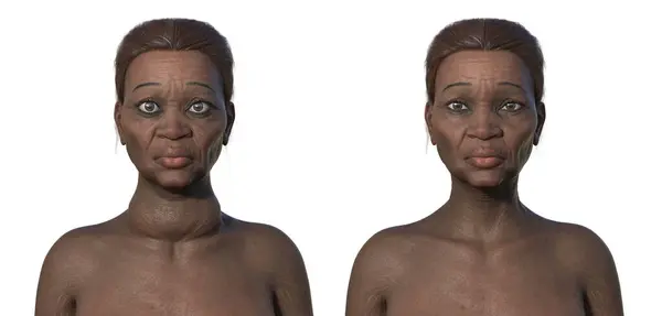 Иллюстрация Сравнивает Пожилую Африканскую Женщину Болезнью Грейвса Увеличенная Щитовидная Железа — стоковое фото
