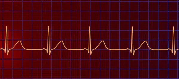 Illustration Eines Elektrokardiogramms Ekgs Das Ein Verlängertes Intervall Mit Breit Stockfoto