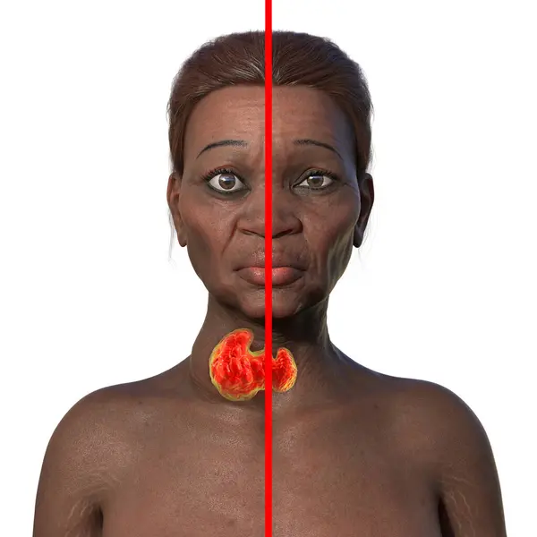 Иллюстрация Сравнивает Пожилую Африканскую Женщину Болезнью Грейвса Увеличенная Щитовидная Железа Лицензионные Стоковые Фото