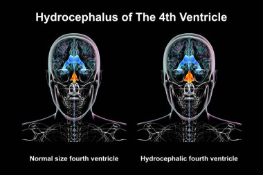 A 3D scientific illustration depicting isolated enlargement of the fourth brain ventricle (right) compared to the normal size fourth ventricle (left), front view. clipart