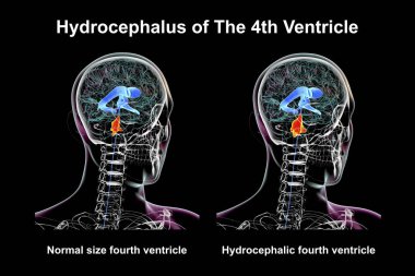A 3D scientific illustration depicting isolated enlargement of the fourth brain ventricle (right) compared to the normal size fourth ventricle (left). clipart