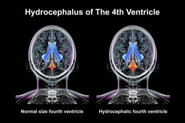 A 3D scientific illustration depicting isolated enlargement of the fourth brain ventricle (right) compared to the normal size fourth ventricle (left), top view. clipart