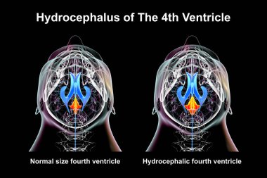 A 3D scientific illustration depicting isolated enlargement of the fourth brain ventricle (right) compared to the normal size fourth ventricle (left), bottom view. clipart
