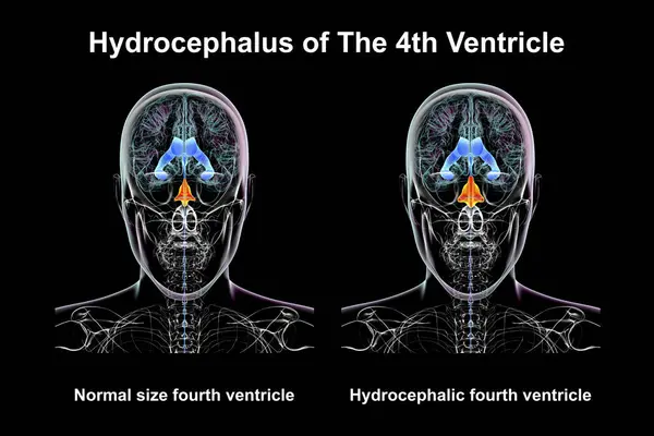 Scientific Illustration Depicting Isolated Enlargement Fourth Brain Ventricle Right Compared — Stock Photo, Image