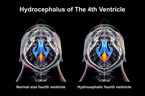 stock image A 3D scientific illustration depicting isolated enlargement of the fourth brain ventricle (right) compared to the normal size fourth ventricle (left), bottom view.