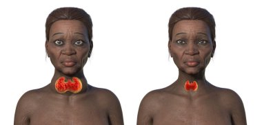 3D illustration compares an elderly African woman with Graves' disease (enlarged thyroid, exophthalmos) and her healthy counterpart. clipart