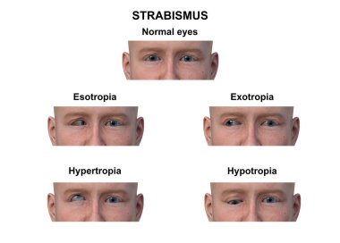 Çeşitli strabismus tiplerine sahip bir adamın 3D çizimi: esotropia, exotropia, hypertropia ve hipotropia..