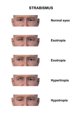 Çeşitli strabismus tiplerine sahip bir adamın 3D çizimi: esotropia, exotropia, hypertropia ve hipotropia..