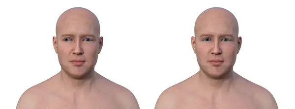 一个有外斜视的男人和一个健康的人三维图解显示外部眼睛对齐不对齐 — 图库照片