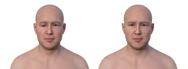 Ein Mann Mit Hypotropie Und Dieselbe Gesunde Person Illustration Mit Stockfoto