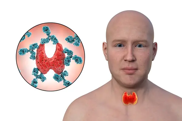Ілюстрація Чоловіком Підсвіченою Щитовидною Залозою Зображує Аутоімунну Хворобу Хасімото Антитілами Стокове Зображення