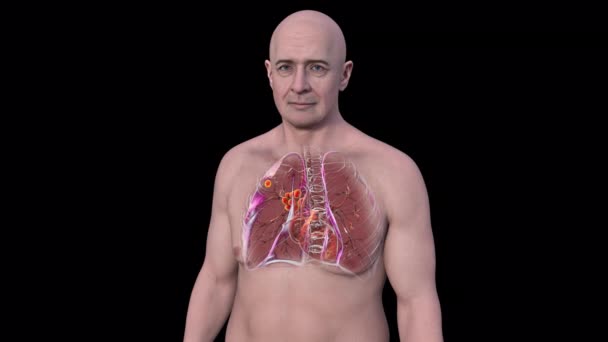Анімація Показує Туберкульоз Легенів Європейської Людини Чорному Тлі — стокове відео