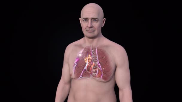 Animação Mostrando Pulmões Tuberculose Homem Europeu Fundo Preto — Vídeo de Stock