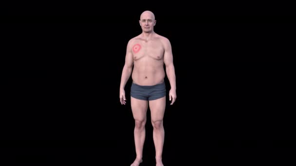 배경에 남자의 Lyme 질병을 보여주는 애니메이션 — 비디오