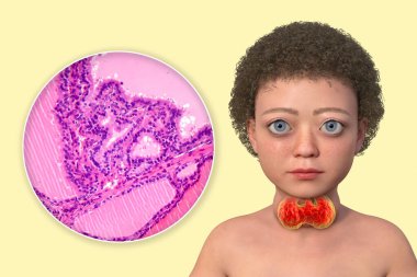 A child with Graves' disease, 3D illustration displaying enlarged thyroid gland (goiter) and bulging eyes (exophthalmos), along with a light micrograph of a toxic goiter. clipart