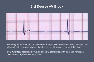3. derece AV bloklu bir ECG görselleştirmesi, atriyal ve ventriküler ritimler arasında tam ayrışma gösteriyor.
