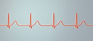 Geniş tabanlı T-dalgalarıyla uzun QT aralığı gösteren bir elektrokardiyogramın (ECG) 3 boyutlu çizimi, tip 1 uzun QT sendromunun karakteristiği.