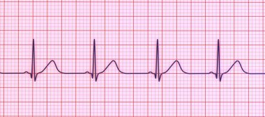 Geniş tabanlı T-dalgalarıyla uzun QT aralığı gösteren bir elektrokardiyogramın (ECG) 3 boyutlu çizimi, tip 1 uzun QT sendromunun karakteristiği.