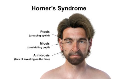 A man with Horner syndrome, 3D illustration depicting ptosis and miosis due to sympathetic nerve disruption. clipart