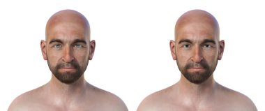 A man with miosis (constricted eye pupils) and the same healthy person, 3D illustration. clipart