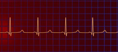 ECG of type 3 long QT syndrome, 3D illustration showing late onset T waves being preceded by a long isoelectric segment. clipart