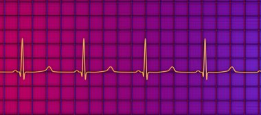 ECG of type 3 long QT syndrome, 3D illustration showing late onset T waves being preceded by a long isoelectric segment. clipart