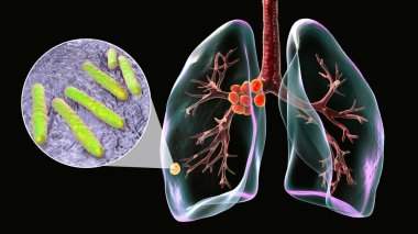 Primary lung tuberculosis, 3D illustration featuring the Ghon complex and mediastinal lymphadenitis, alongside with close-up view of Mycobacterium tuberculosis bacteria. clipart