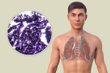 3D illustration and light micrograph depicting a man with lungs affected by silicosis, revealing dark silicotic nodules, emphasizing respiratory health issues due to silica exposure. clipart