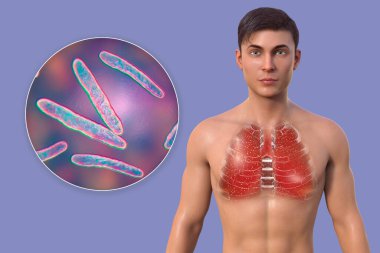 Şeffaf derili bir adamı gösteren üç boyutlu bir resimde, militer tüberkülozdan etkilenen akciğerler ve Mycobacterium tüberküloz bakterisinin yakın plan görüntüsü görülüyor..