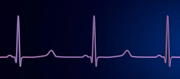 stock image ECG of type 3 long QT syndrome, 3D illustration showing late onset T waves being preceded by a long isoelectric segment.