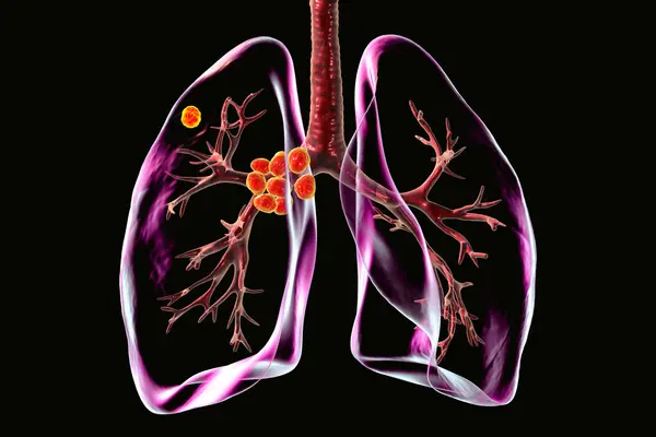 stock image Primary lung tuberculosis, 3D illustration featuring the Ghon complex and mediastinal lymphadenitis.